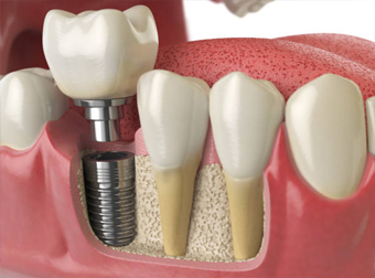 Closeup of a dental implant being placed
